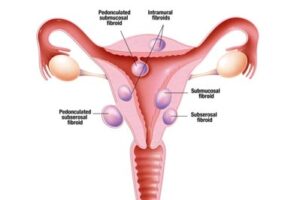 جدیدترین روش درمان فیبروم رحم