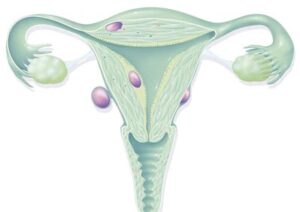 جدیدترین روش درمان فیبروم رحم