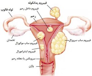 جدیدترین روش درمان فیبروم رحم