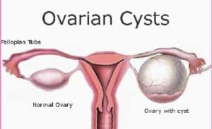 درمان کیست تخمدان بدون دارو