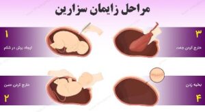 بهترین زمان برای سزارین هفته چندم است