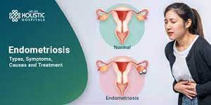 بهترین دارو برای درمان اندومتریوز