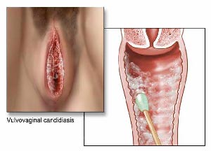علت درمان نشدن عفونت قارچی واژن