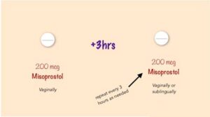 عوارض قرص میزوپروستول زیر زبانی
