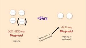 عوارض قرص میزوپروستول زیر زبانی