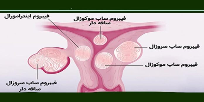 دفع شدن فیبروم در پریودی