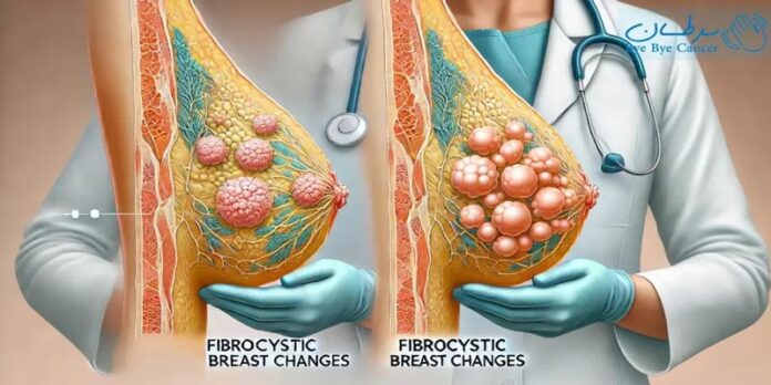 ایا فیبروکیستیک تبدیل به سرطان می شود