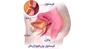 علت خروج باد از واژن هنگام نزدیکی